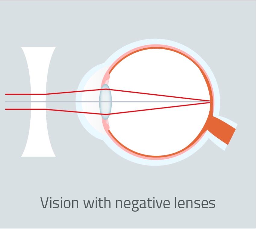 Negative-lenses-vison-EN
