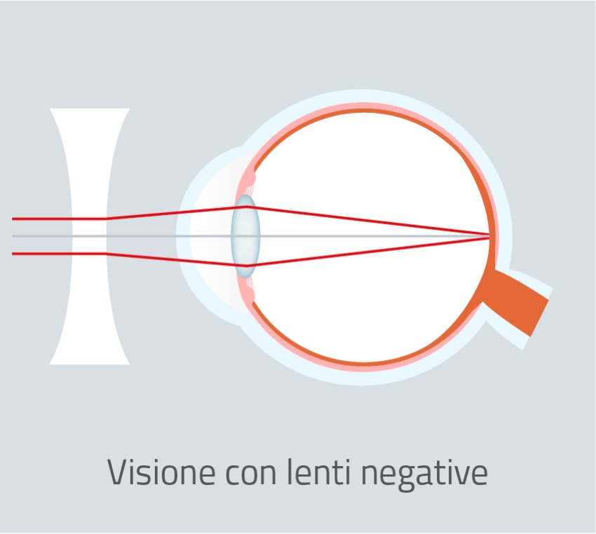 Negative-lenses-vison