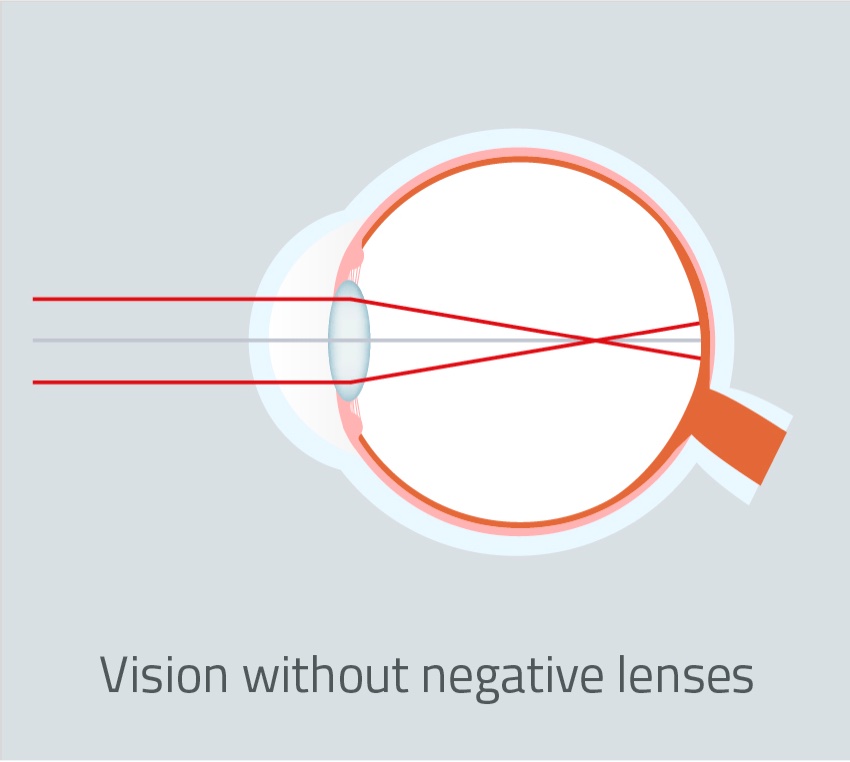 No-Negative-lenses-vison-EN