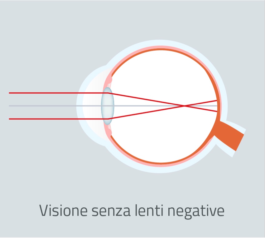 No-Negative-lenses-vison