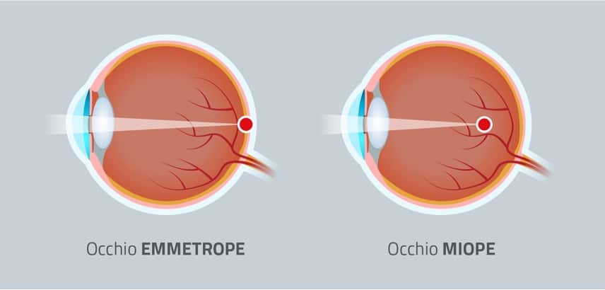 EMMETROPE-MYOPE-IT